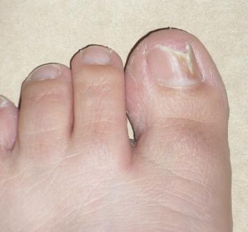 Vad är behandlingen av nagelsvampen på husets ben och med hjälp av läkemedelspreparat?