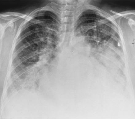 Orsaker till lungödem och prinitspy behandling av detta patologiska tillstånd